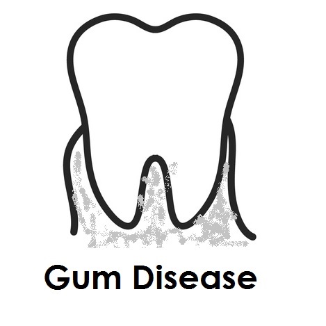 Gum Disease